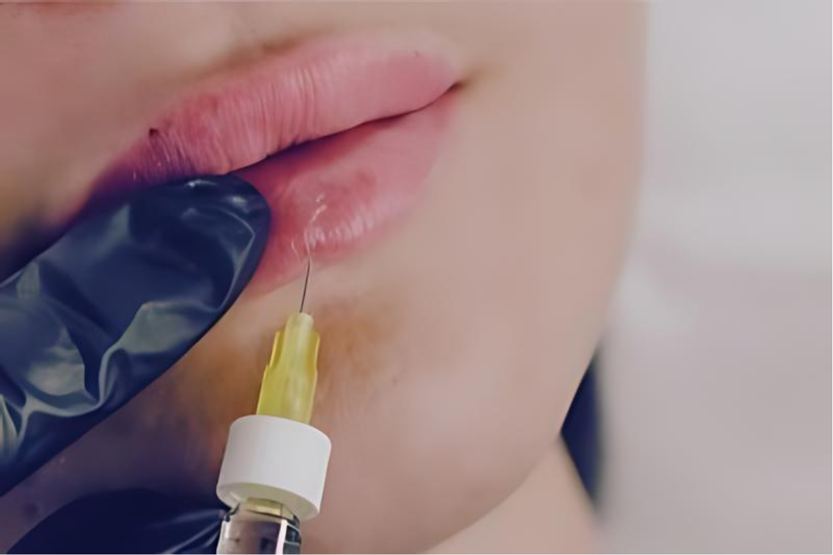 Shrewsbury-dermal-filler, lips, lip-filler, cheek-filler, hyaluronic-acid, shropshire-aesthetics, shropshire-health